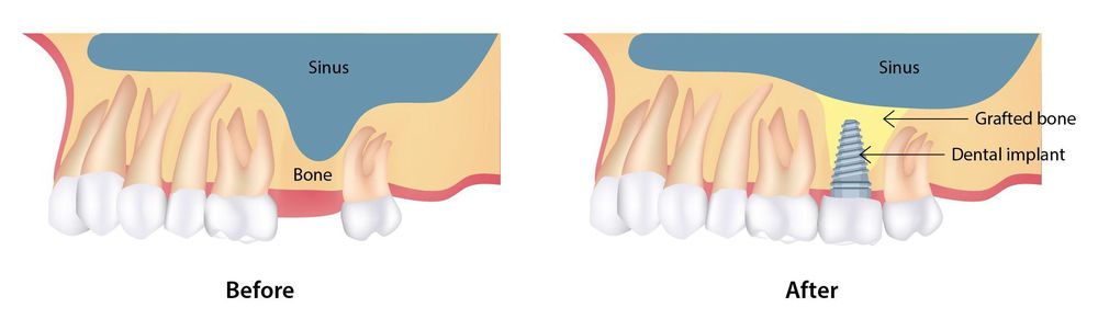 Before and after sinus lift