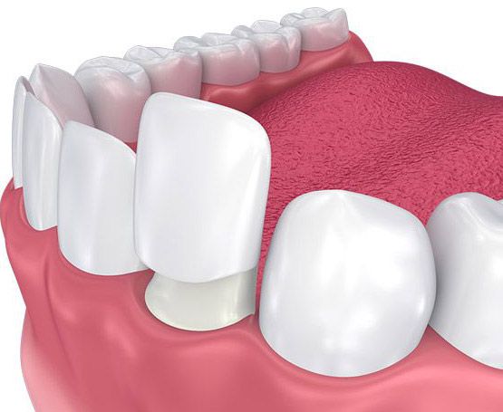 A veneer fits over the front of a tooth