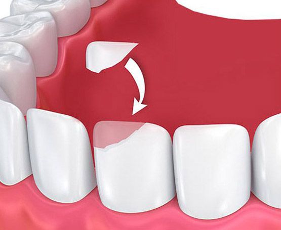Dental bonding fixes a chipped tooth
